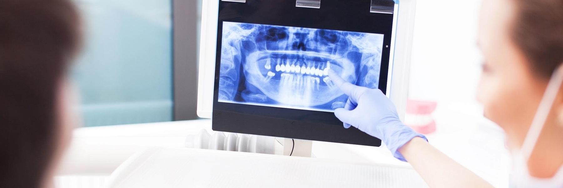 Tooth Extraction | Dentist